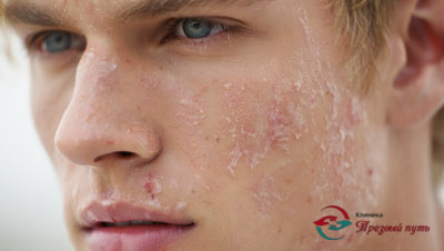 Мужчина с признаками аллергии на лице